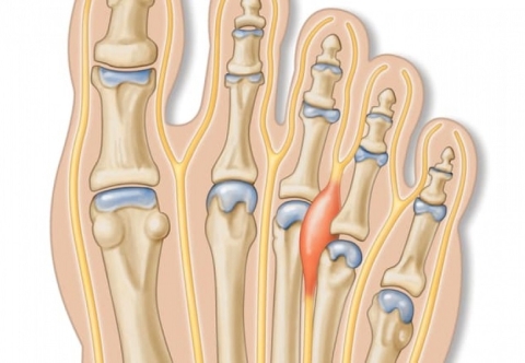Vì sao nhiều người thừa cân béo phì cảm giác có vật lạ trong giày?
